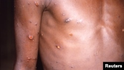 მაიმუნის ჩუტყვავილით დაავადებული ადამიანი