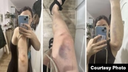 ასე გამოიყურებოდა ნათია ჩიქოვანის ხელები და ფეხი სასამართლოს მეორე დღეს