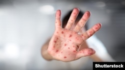 В міністерстві стверджують, що найчастіше хворіють в тих областях, де найменше вакцинованих дорослих і дітей