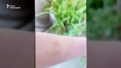 ლუკას დედის დაზიანებები ლუკას დედის დაზიანებები