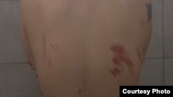 დაზიანებები ერთ-ერთი ქალის ზურგზე