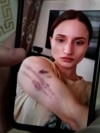 Фотография Айшат Баймурадовой со следами домашнего насилия